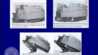 DENT 718 Rotational path partial dentures [upl. by Crowell]