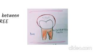 Dentigerous Cyst  Pathogenesis [upl. by Airreis]