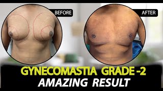 Gynecomastia Surgery in Jaipur  Patient Feedback  Dr Deepesh Goyal  Rejuvena Cosmo Care [upl. by Latvina687]