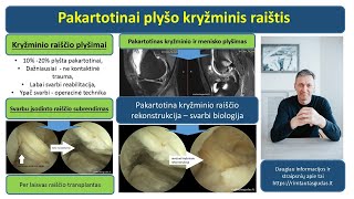 Pakartotinai plyšo kryžminis raištis [upl. by Ashia]