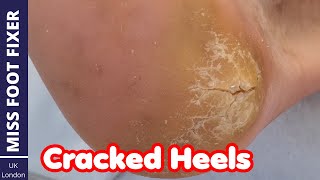 HOW TO TREAT DRY  CRACKED HEELS  CRACKED FOOT TREATMENT  BY MISS FOOT FIXER [upl. by Cram]