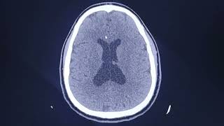 Male 24 year old  Increased Intracranial Pressure  CT findings [upl. by Nidla]