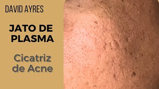 Tratamento para cicatriz de acne com Jato de Plasma [upl. by Vi]