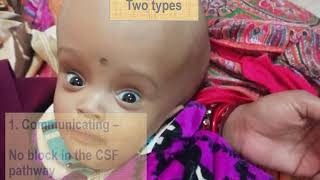 Hydrocephalus in children  Pediatrics [upl. by Ernestine944]