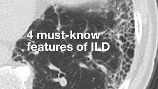 4 MustKnow Features of ILD [upl. by Ruder]