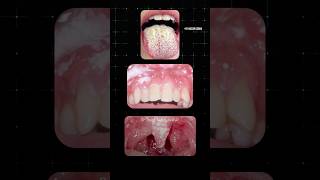 வாயில் ஏற்படும் பூஞ்சை தொற்று Oral Thrush Dr Isacc Abbas [upl. by Conard457]