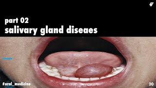 salivary gland diseases 2  oral medicine  عزت شومان [upl. by Snashall]