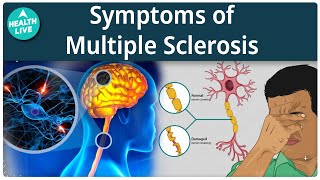 What Are The Symptoms Of Multiple Sclerosis  Sclerosis  Health Live [upl. by Nehcterg]