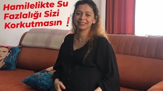 Hamilelikte Su Fazlalığı  Amniyon Sıvısı Neler Yaşadım Doktorlar Neler Tavsiye Etti [upl. by Atinwahs324]