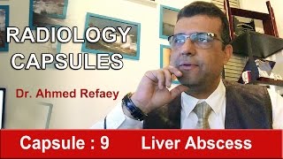 Capsule  9  Liver Abscess [upl. by Dreda557]