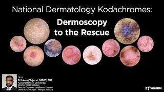 National Dermatology Kodachromes Dermoscopy to the Rescue [upl. by Alejoa]