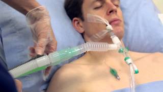 Using Intersurgicals TrachSeal™ closed suction systems [upl. by Dnomso]