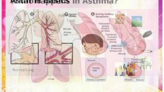 Asthma inhaler and spacer usePart 1 [upl. by Hubing]