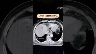 Liver Hemangioma CT abdomen shorts youtubeshorts viral [upl. by Akaenahs867]