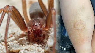 Brown Recluse Spider Bite Story 🕷 They Nearly Lost Their Leg [upl. by Charmion794]