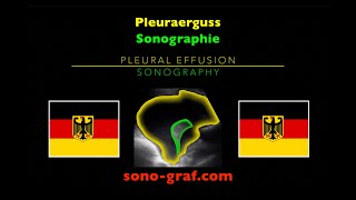 Sonographie  Pleuraerguss [upl. by Glad33]