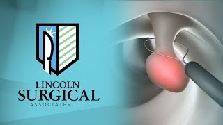 Polyp Removal  Dr Deirdre Hart Colon and Rectal Surgeon  Lincoln Surgical Associates Shiloh IL [upl. by Eisiam319]