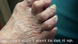 Trimming Really Thick Nails in Podiatry office [upl. by Norred]