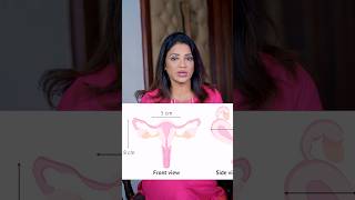 क्या Bicornuate uterus में Pregnancy हो सकती है sonaamedihub drsonalparihar gynaecologist [upl. by Bard]