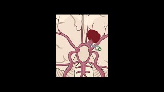 Neurosurgical clipping aneurysm shorts anatomy science [upl. by Chinua]