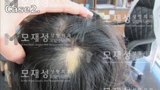 흉터부위 두피문신 시술 전후 영상입니다 scalp micropigmentation treatment [upl. by Marjory]