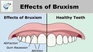 Effects of Teeth Grinding  Bruxism [upl. by Akimihs]