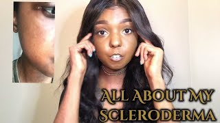 Living With Scleroderma  All about my scleroderma [upl. by Lavina]