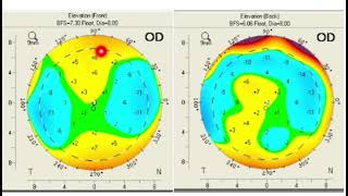 Pentacam interpretation case based study [upl. by Pacien]