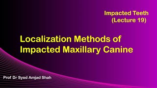 Localization Methods of Impacted Maxillary Canine  Oral amp Maxillofacial Surgery  Syed Amjad Shah [upl. by Enileme]