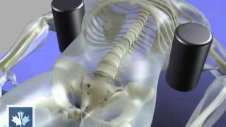 Sciatica  Spinal Decompression  Back Clinics of Canada [upl. by Dodi]