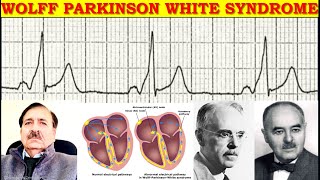 Arrhythmias associated with Wolff Parkinson White Syndrome  Lectures by Dr Alamzeb [upl. by Nirek]