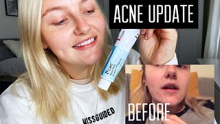 ACNE UPDATE  Duac gel  Rhiannon Mair [upl. by Nrobyalc]