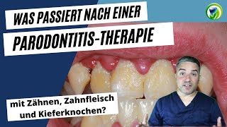 Was passiert mit Zähnen Zahnfleisch und Kieferknochen bei einer Parodontitistherapie [upl. by Hillhouse]