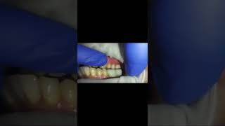 Excess prosthetic space in lower missing molarsimmediate loadingdental implants resorbed Mandible [upl. by Elbertine882]