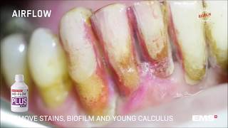 GBT Step 04 Stains biofilm and young calculus removal with AIRFLOW® and PLUS powder [upl. by Adnwahsat407]