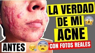 LA HISTORIA QUE NUNCA CONTÉ SOBRE MI ACNÉ 😖  ¡ELIMINA TU ACNÉ PARA SIEMPRE Fotos Reales [upl. by Rosabella]