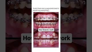 How Braces Work TimeLapse of Teeth Alignment  Daily Dentists [upl. by Luoar]