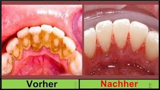 KEIN SCHERZ Entferne deinen Zahnbelag in 2 Minuten ohne zum Zahnarzt zu gehen [upl. by Neirbo]