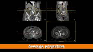 Multiplanar reconstruction [upl. by Feigin]