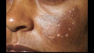 WAJIGA HARAHA LEH SIIDA LOGA NADIIFIYO HYPERPIGMENTATION CURE [upl. by Jeff]