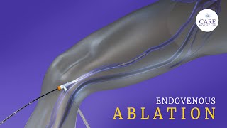 What is Endovenous Laser Ablation CARE Hospitals [upl. by Coates]