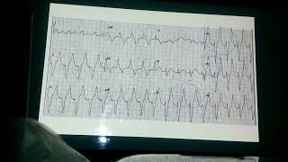 continuación de Taquiarritmias [upl. by Vanessa]
