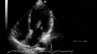 echocardiogram  chordal rupture 22 [upl. by Azaleah]