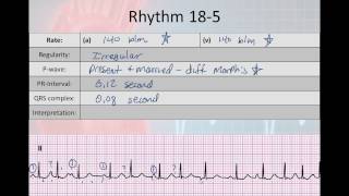 Basic Electrophysiology part 7  Atrial Rhyhtms part 2 WAP MAT EAT SVT [upl. by Budding]