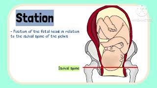 Bishop Score Induction of labour in pregnancy Obstetrics [upl. by Joan]