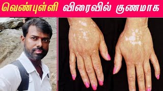 வாங்க ஃபிரண்ட்ஸ் கன்னியாகுமரி மருத்துவத்திற்கு போகலாம் 🌿 Vitiligo Treatment Awareness [upl. by Schubert]