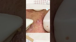 Big Cystic Acne Blackheads Extraction Blackheads amp Milia Whiteheads Removal Pimple Popping shorts [upl. by Ardnaed128]