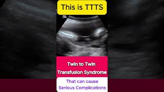 TTTS  Twin to Twin Transfusion Syndrome Ultrasound  Monochorionic TWINS [upl. by Sergo]