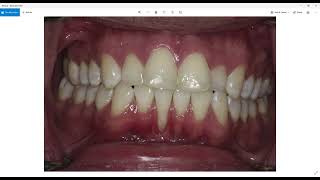 Can I do an alloderm gum graft on my tooth What factors affect if I can use human donor tissue [upl. by Bettzel]