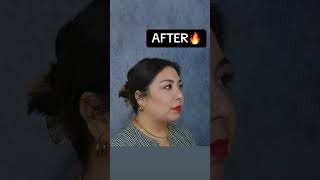 Chin Implant  Chin Lipo RESULTS 🔥 plasticsurgery plasticsurgeon glowup chinimplant chinlipo [upl. by Sumner941]